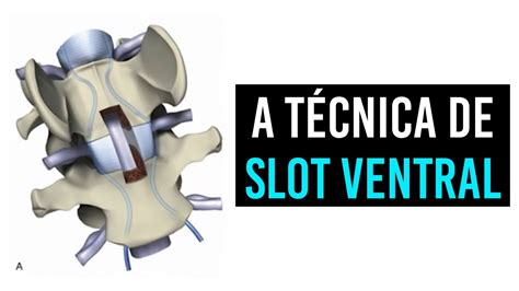 Ventral Slot Procedimento Em Caes